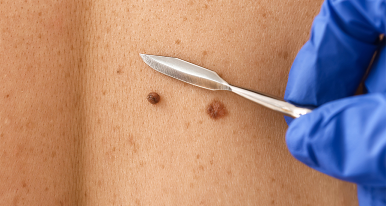 Mole and skin tag removal