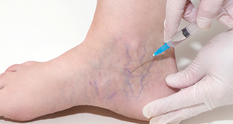sclerotherapy / vein treatment