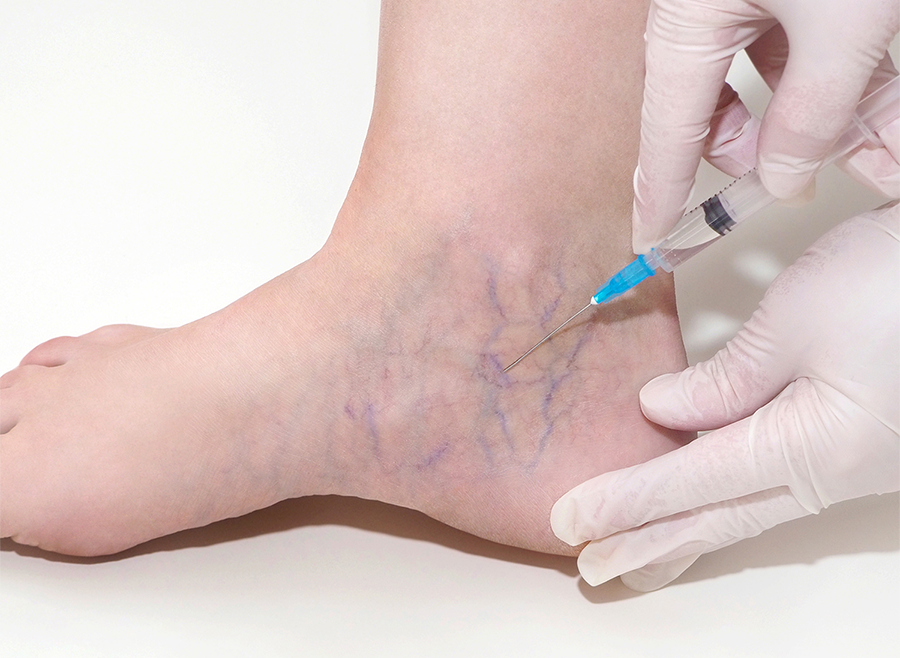 sclerotherapy / vein treatment