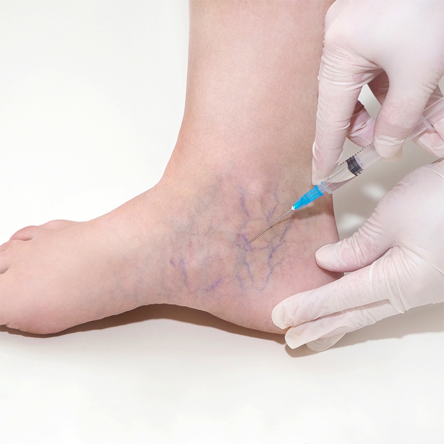 Sclerotherapy Vein Treatment Drd 6575